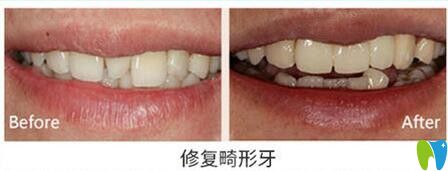 天津美奧口腔修復畸形牙齒對比圖
