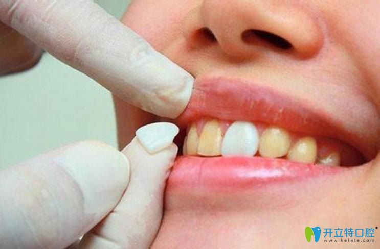 泉州維樂口腔李翠鳳醫(yī)生科普牙齒瓷貼面優(yōu)勢