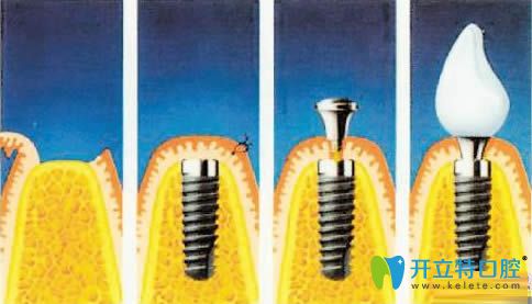 候國(guó)鎮(zhèn)醫(yī)生擅長(zhǎng)各類(lèi)種植牙手術(shù)