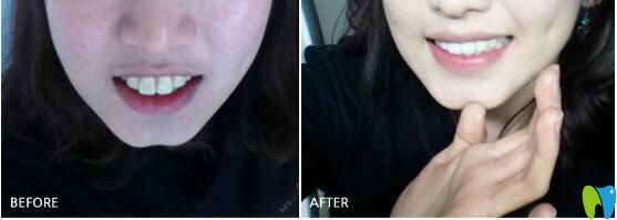 團(tuán)圓口腔矯正案例對(duì)比圖