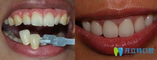 東莞好佰年口腔牙齒貼面修復(fù)效果