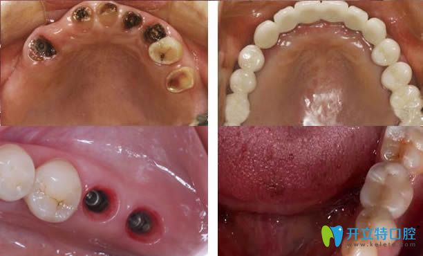 東莞好佰年口腔牙齒種植案例圖