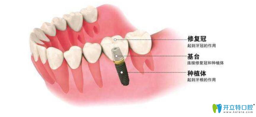了解種牙牙冠價(jià)格前，先弄清楚種植牙牙冠有哪些種類
