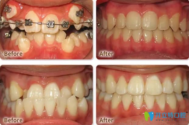 東莞好佰年口腔正畸案例效果圖