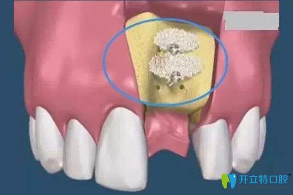 牙槽骨萎縮想做種植牙的補(bǔ)救方法