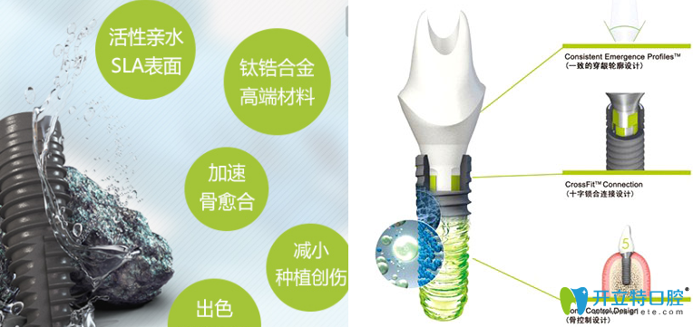 瑞士iti種植體優(yōu)勢(shì)