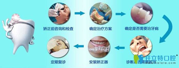 正畸知識(shí)分享：牙齒矯正詳細(xì)步驟和過程圖解
