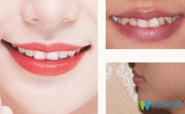 深圳格倫菲爾口腔矯正牙齒怎么樣呢？來(lái)看看真人正畸案例