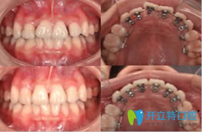佛山拜爾口腔成人牙齒美學(xué)矯正案例效果圖 佛山拜爾口腔成人牙齒美學(xué)矯正案例效果圖