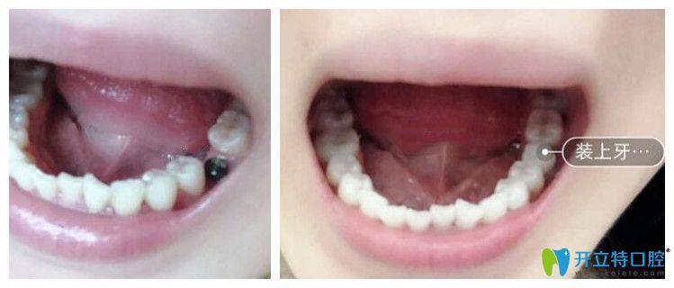 成都圣貝牙科即刻種植牙案例 成都圣貝牙科即刻種植牙案例
