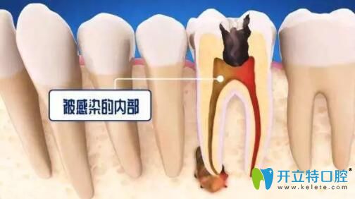 死髓牙不處理會怎么樣