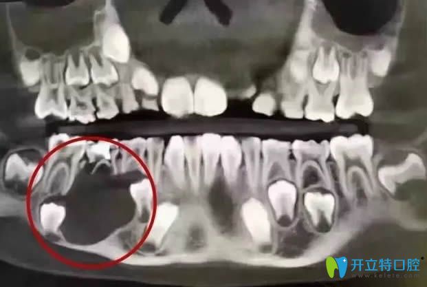 小孩下頜骨破壞后的成像圖