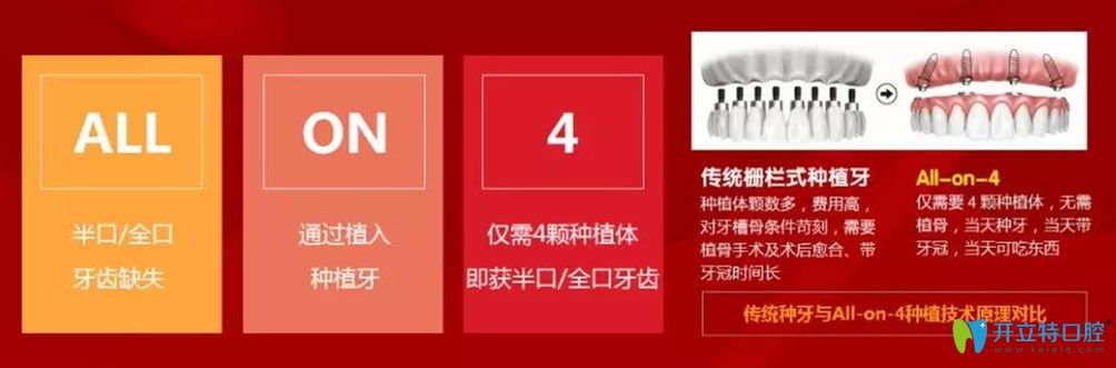 北極星口腔All-on-4即刻負重種植技術(shù)