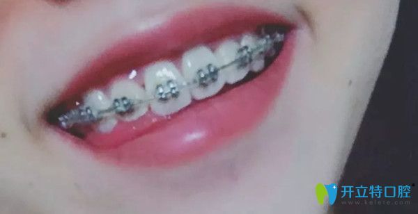 口腔正畸半年后的變化圖 口腔正畸半年后的變化圖