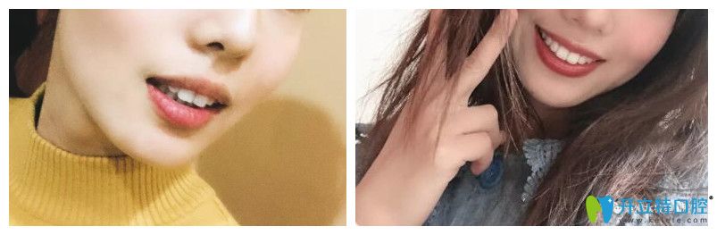 泰州北極星口腔隱形矯正案例前后效果對比圖