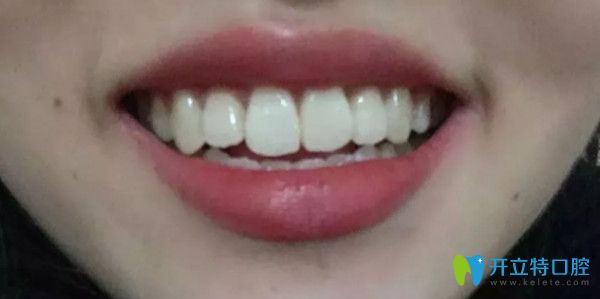 牙齒矯正前后對(duì)比圖 牙齒矯正前后對(duì)比圖