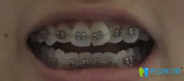 戴上3M自鎖托槽矯正器的照片 戴上3M自鎖托槽矯正器的照片