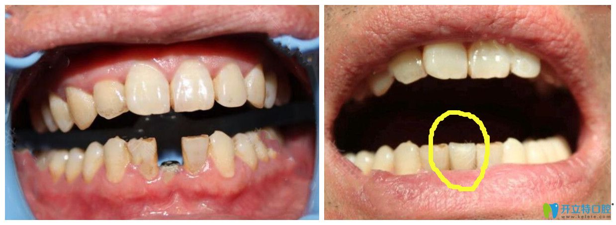 中山好民生口腔收費貴嗎?牙齒矯正及種植牙顧客來告訴你