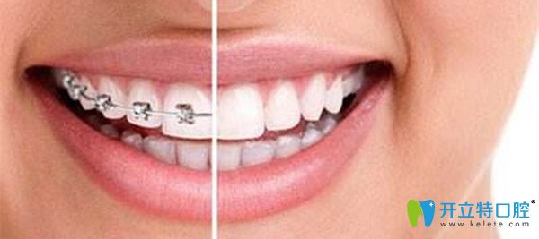 列舉深圳牙齒矯正好且正規(guī)的口腔機(jī)構(gòu),附價(jià)格表及顧客評價(jià)