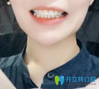 <!--<i data=20240703-sp></i>-->口腔陶瓷托槽隱形矯正術后1年半效果圖