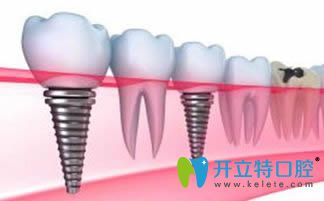 周宇醫(yī)生擅長(zhǎng)各類種植牙技術(shù)