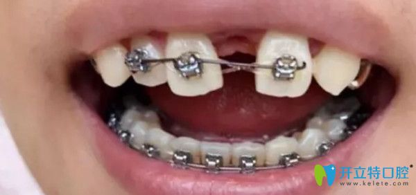 拔了一顆上牙后戴上了上牙套
