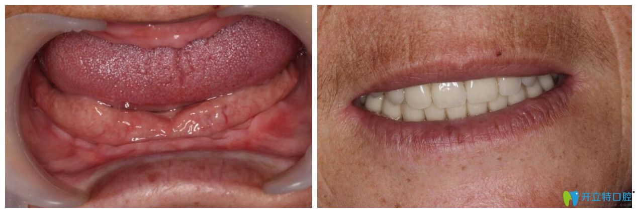 下頜過度吸收，舌體過大的顧客做吸附性全口義齒