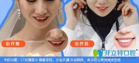 仁愛口腔牙齒外漏、擁擠矯正案例