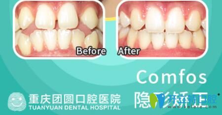 團(tuán)圓口腔牙齒稀疏采用時(shí)代天使隱形矯正前后效果對(duì)比