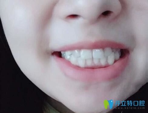 廣州廣大口腔張力醫(yī)生給我做種植牙后