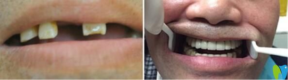 <!--<i data=20240703-sp></i>-->口腔全口牙即刻負(fù)重種植案例前后效果對比