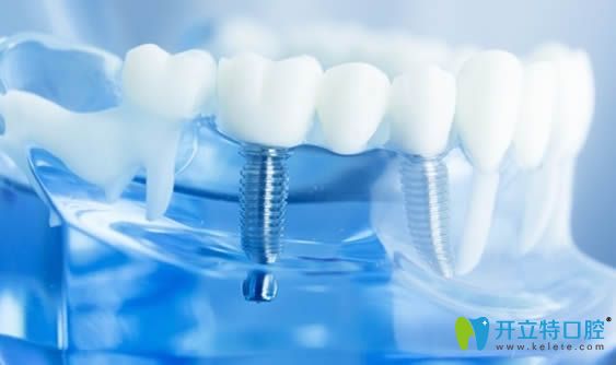 種植牙后可以做牙齒矯正嗎