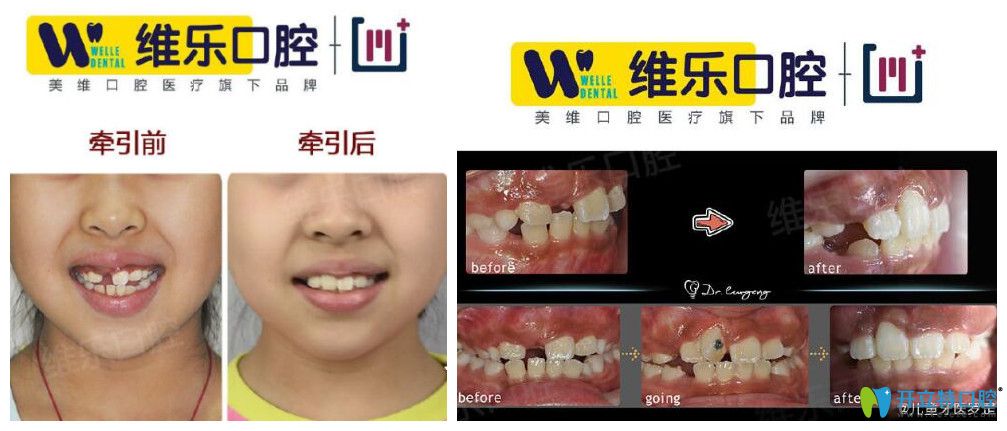 北京維樂(lè)口腔羅罡博士埋伏牙矯正案例