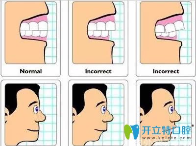 鐘紅醫(yī)生表示對于兒童錯頜畸形應采取早期預防和干預治療