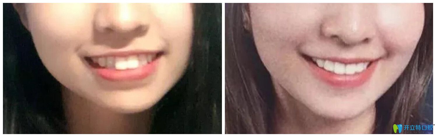 藝星口腔牙齒矯正案例前后效果對(duì)比圖