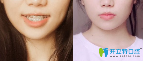 <!--<i data=20240703-sp></i>-->圣康牙科做牙齒反頜矯治術(shù)中照