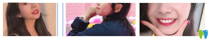 格倫菲爾正畸效果圖