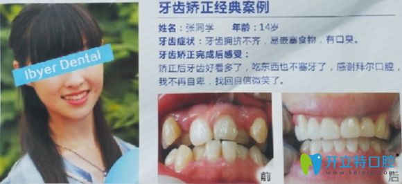 深圳拜爾口腔牙齒矯正案例前后效果對比圖