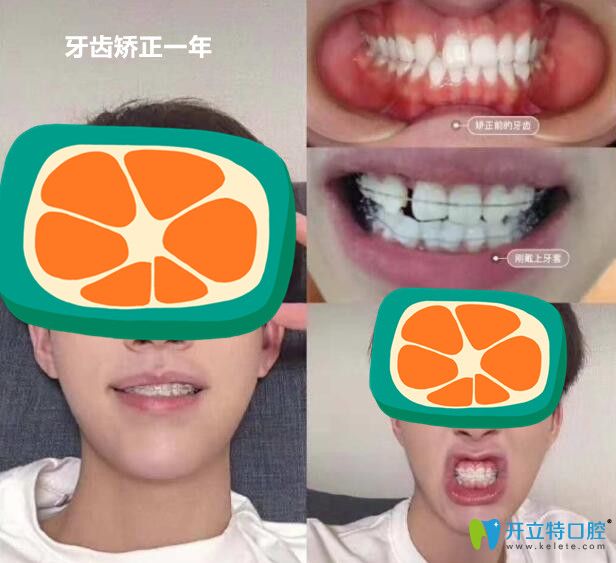 小哥哥在順德壹加壹做半隱形陶瓷矯正中牙齒變化過程圖