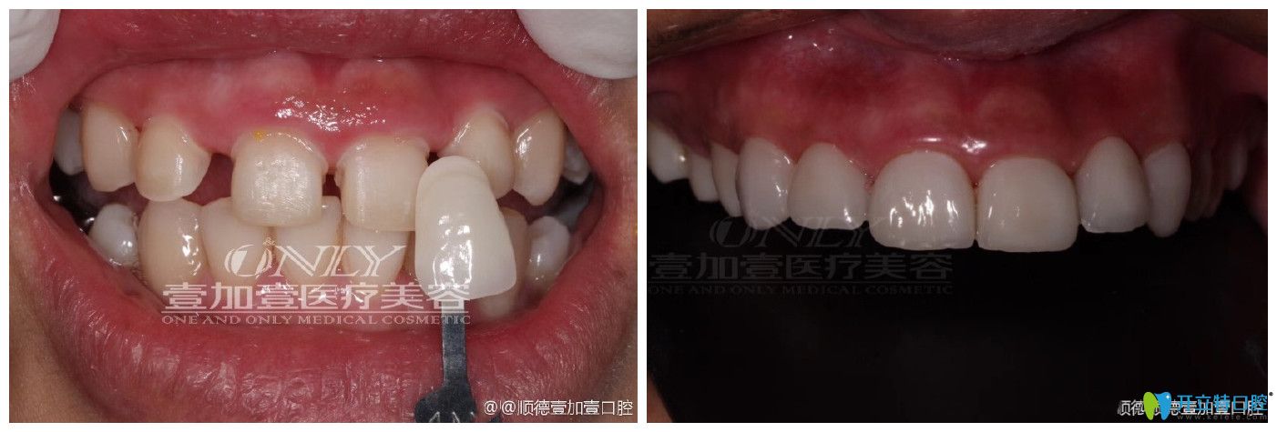 佛山順德壹加壹口腔牙貼面修復牙齒縫隙大案例前后效果對比