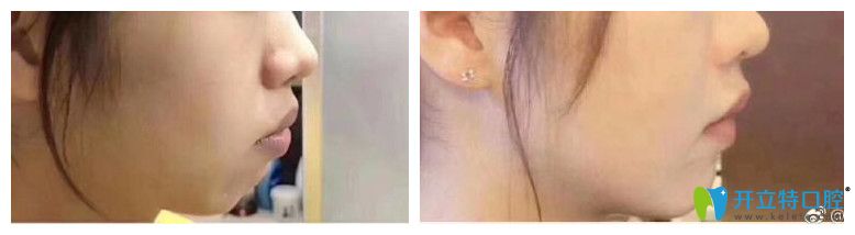 壹加壹牙齒矯正前后臉型變化圖對比效果