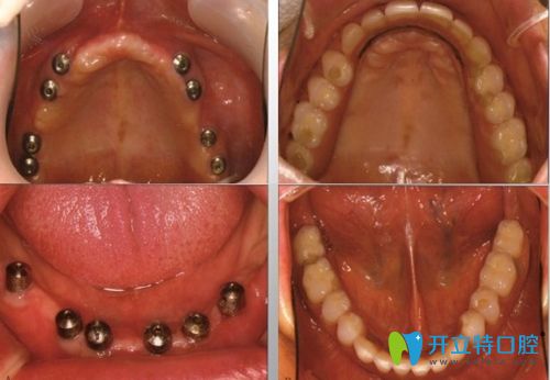 深圳諾德齒科全口種植牙效果圖