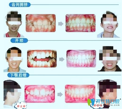 長(zhǎng)沙中諾口腔青少年牙齒矯正案例
