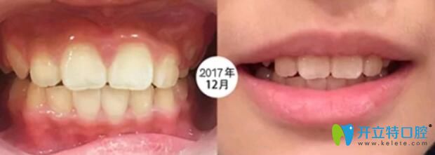 8歲的兒子在成都河馬口腔做矯正6個月 8歲的兒子在成都河馬口腔做矯正6個月