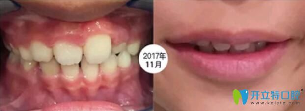 孩子在成都河馬口腔做矯正第4個月 孩子在成都河馬口腔做矯正第4個月