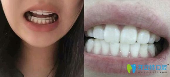 濟南韓氏口腔金屬牙套矯正術(shù)后效果很贊 濟南韓氏口腔金屬牙套矯正術(shù)后效果很贊