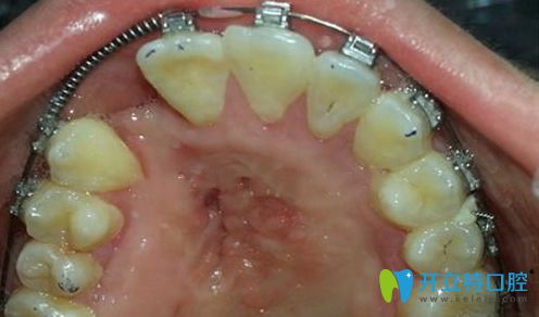 唇腭裂做牙齒矯正的圖片