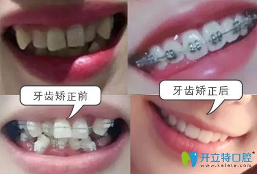 珠海九龍口腔牙齒矯正前后效果對(duì)比圖