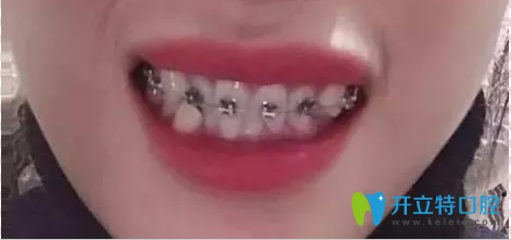 珠海九龍口腔牙齒矯正半年效果 珠海九龍口腔牙齒矯正半年效果
