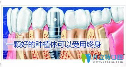 韓國(guó)登騰種植體壽命是多少年